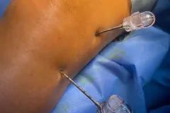 infiltracion_rodilla