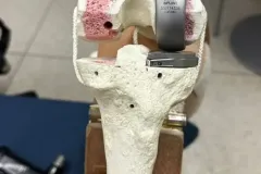 rodilla_unicompartimental