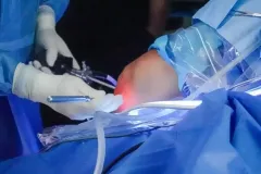 artroscopia_de_rodilla